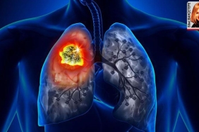 akciger-kanseri-dunyada-en-sik-ortaya-cikan-ikinci-kanser-rlHl3qBV.jpg