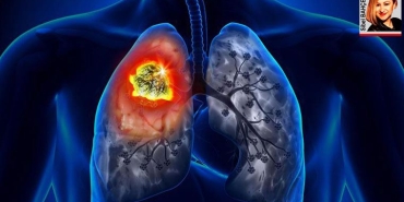 akciger-kanseri-dunyada-en-sik-ortaya-cikan-ikinci-kanser-rlHl3qBV.jpg