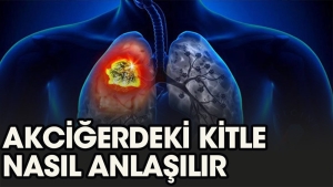 akcigerdeki-kitle-nasil-anlasilir-1HMVVUgQ.jpg
