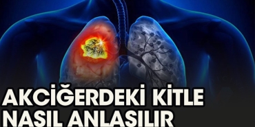 akcigerdeki-kitle-nasil-anlasilir-1HMVVUgQ.jpg