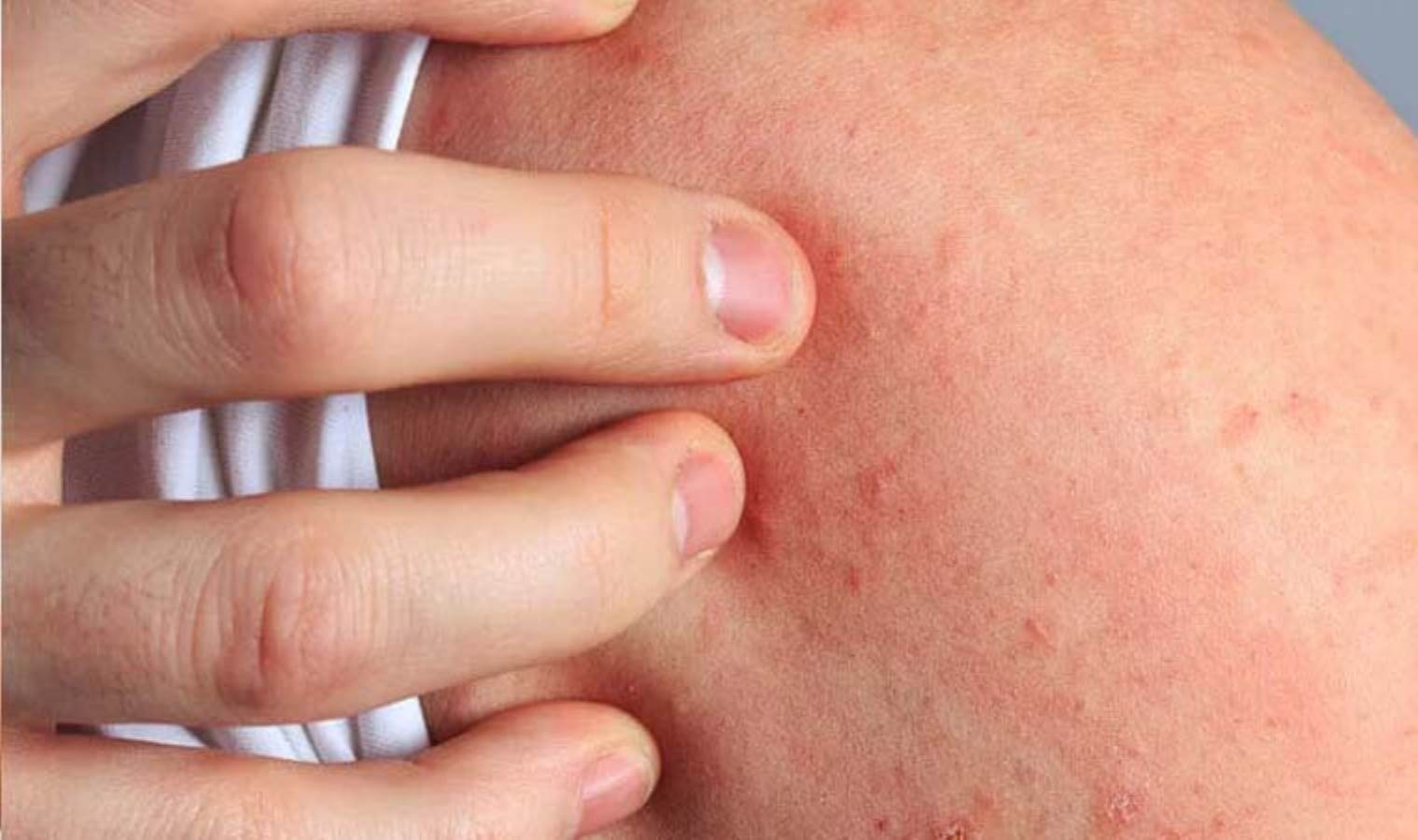 Histamin İntoleransının Sebepleri Nelerdir?