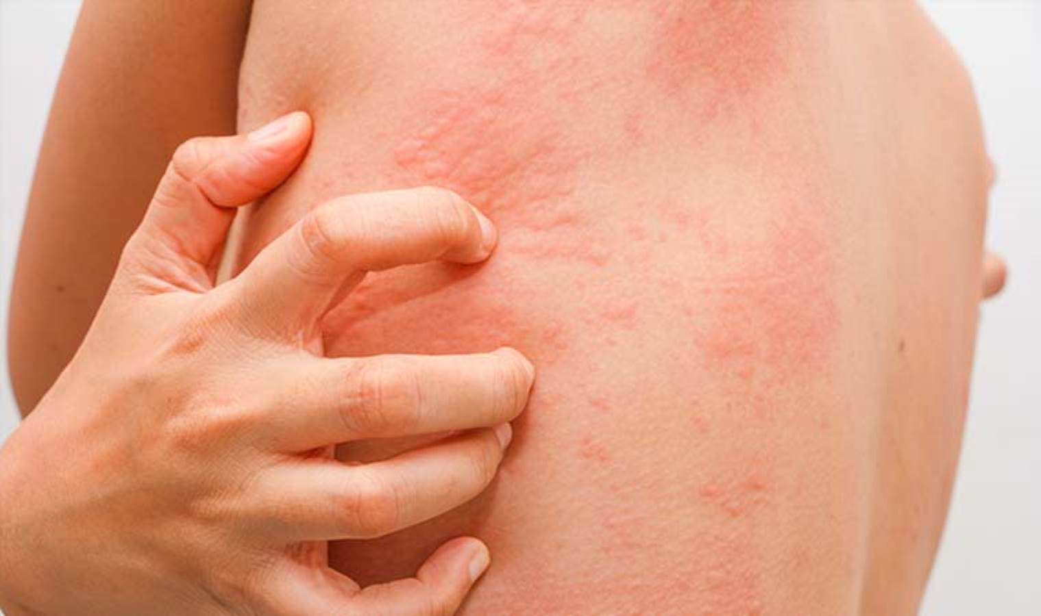 Histamin Alerjisi Belirtileri Nelerdir?