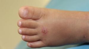 impetigo-nedir-belirtileri-nedenleri-ve-tedavisi-WuNedijK.jpg