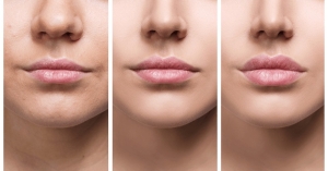 lip-lift-hakkinda-bilinmeyenler-jgtc6Bid.jpg
