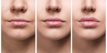 lip-lift-hakkinda-bilinmeyenler-jgtc6Bid.jpg