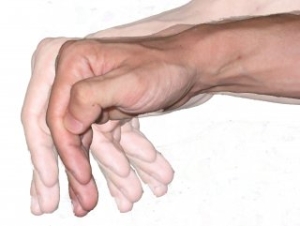 parkinson-hastaligi-nedir-SYM9MfPB.jpg