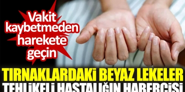 tirnaginizdaki-beyaz-lekeler-tehlikeli-hastaligin-habercisi-vakit-kaybetmeden-harekete-gecin-nBPykPyt.jpg