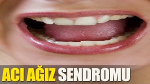 aci-agiz-sendromu-nedir-bw3QcJOw.jpg