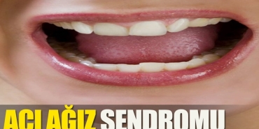 aci-agiz-sendromu-nedir-bw3QcJOw.jpg