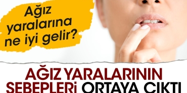 agiz-yaralarinin-sebepleri-ortaya-cikti-agiz-yaralarina-ne-yeterli-gelir-KjCf71YN.jpg