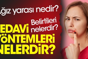 agiz-yarasi-nedir-agiz-yarasi-belirtileri-nelerdir-agiz-yarasi-tedavi-metotlari-nelerdir-NfXy2VOH.jpg
