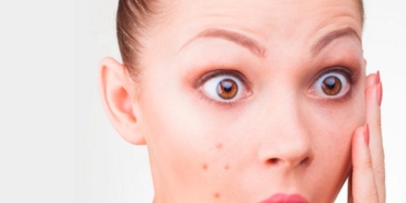 akne-sivilce-hastaligi-akne-nedir-fylbDZjI.jpg