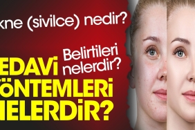 akne-sivilce-nedir-belirtileri-nelerdir-tedavi-yollari-nelerdir-75Ssgq9i.jpg