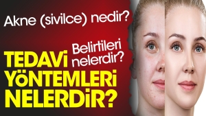 akne-sivilce-nedir-belirtileri-nelerdir-tedavi-yollari-nelerdir-75Ssgq9i.jpg