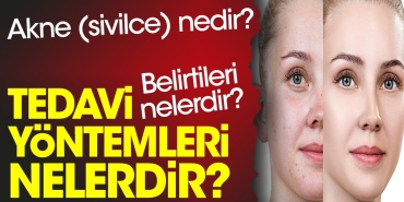 akne-sivilce-nedir-belirtileri-nelerdir-tedavi-yollari-nelerdir-75Ssgq9i.jpg