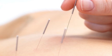 akupunktur-nedir-GEf2Oaeb.jpg