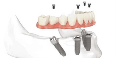 all-on-4-teknigi-nedir-ugM6Icez.jpg