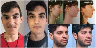 ameliyatsiz-operasyonsuz-cene-cizgisini-belirginlestiren-ve-jawline-dolgusu-tesiri-yaratan-idman-mewing-Ytg9wCE1.jpg
