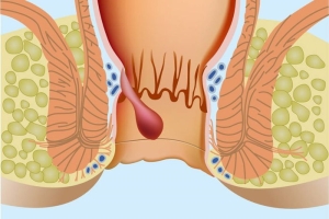 anal-fissur-ve-anal-fistul-nedir-SJQE8R5V.jpg