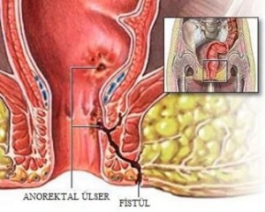anal-fistul-nedir-gdUZ2aep.jpg