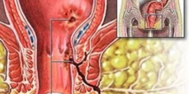 anal-fistul-nedir-gdUZ2aep.jpg