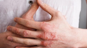 atopik-dermatit-nedir-atopik-dermatit-kimlerde-goruluyor-Fw2s7js9.jpg