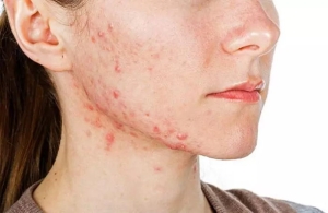 bahar-alerjisi-nedir-belirtileri-ve-tedavisi-z2lpKf4l.jpg