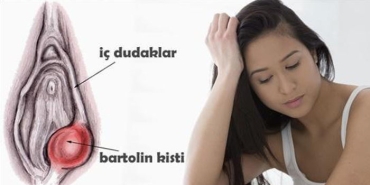 bartholin-kisti-ve-apsesi-nedir-tedavisi-nasil-yapilir-u2nGJMM4.jpg