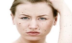 ben-aldirma-nevus-eksizyonu-FJlyM56C.jpg