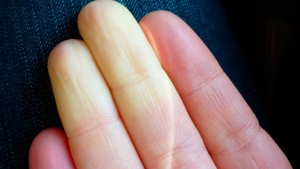 beyaz-parmak-hastaligi-raynaud-sendromu-nedir-raynaud-reyno-sendromu-belirtileri-nelerdir-Dq2yip6Q.jpg