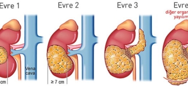 bobrek-tumoru-nedir-FwwjSfyd.jpg