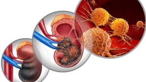 bobrekustu-bezi-hastaliklari-ve-tumorleri-adrenal-tumor-nedir-FQ1HccDH.jpg