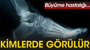 buyume-hastaligi-en-cok-kimlerde-gorulur-9Z9eY6Mf.jpg