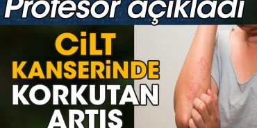 cilt-kanserinde-korkutan-artis-profesor-acikladi-SfzGYBvN.jpg
