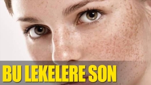 cilt-lekelerine-son-vWmz3Y1D.jpg