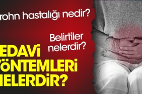 crohn-hastaligi-nedir-belirtileri-nelerdir-tedavi-usulleri-nelerdir-hPuMg6Bm.jpg