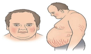 cushing-sendromu-nedir-cushing-sendromu-belirtileri-nelerdir-2kigcHEJ.jpg