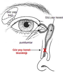 dakriyosistorinostomi-nedir-XGcjhT7K.jpg