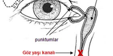 dakriyosistorinostomi-nedir-XGcjhT7K.jpg