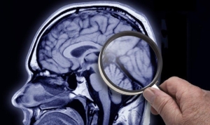 demans-ve-alzheimer-belirtileri-nedir-hangi-tedaviler-uygulaniyor-wKrhADMc.jpg