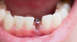 dental-implant-nedir-l7Q2ODFM.jpg