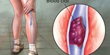 derin-ven-trombozu-nedir-OWYEmKer.jpg