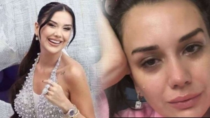 dilan-polatin-kelebek-hastaligi-nedir-lupus-kelebek-hastaligi-belirtileri-neler-JN3mlvBp.jpg