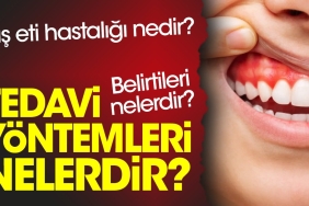 dis-eti-hastaligi-nedir-belirtileri-nelerdir-tedavi-formulleri-nelerdir-JjO71dRw.jpg
