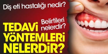 dis-eti-hastaligi-nedir-belirtileri-nelerdir-tedavi-formulleri-nelerdir-JjO71dRw.jpg
