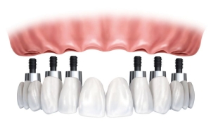 dis-implanti-nedir-dis-implantinin-riski-varmidir-PEuJ3n6e.jpg