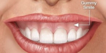 diseti-estetigi-nedir-gummy-smile-diseti-gulusu-nasil-tedavi-edilir-UxPWHqOV.jpg