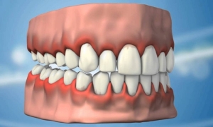 diseti-hastaliklari-tedavisiperiodontoloji-nedir-btFYYnmO.jpg