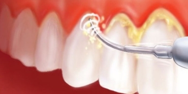 distasi-tartar-nedir-diseti-tedavisi-nasil-gerceklestirilir-KM58tdjD.jpg
