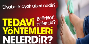diyabetik-ayak-ulseri-nedir-belirtileri-nelerdir-tedavi-metotlari-nelerdir-UQAM8urg.jpg